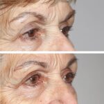 Stunning Transformation: Discover the Remarkable Results of Botox Eyebrow Lift Before and After.