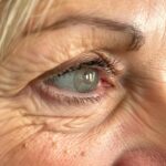 Unlock the Secret to Youthful Eyes: Botox Conquers Crow's Feet. botox-for-crows-feet