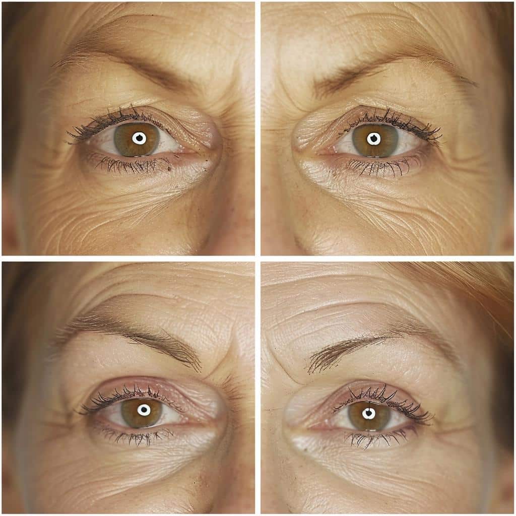 ASTONISHING BEFORE AND AFTER EFFECTS OF BOTOX EYEBROW LIFT REVEALED IN EYEBROW TRANSFORMATION. 2 ASTONISHING BEFORE AND AFTER EFFECTS OF BOTOX EYEBROW LIFT REVEALED IN EYEBROW TRANSFORMATION.