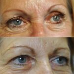 eyebrow-transformation-before-after-effects-botox-lift
