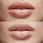 transformative-effects-botox-lips-before-after