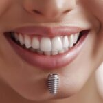 how-much-does-a-full-set-of-teeth-implants-cost